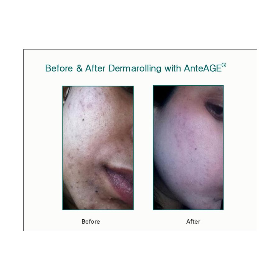anteage serum